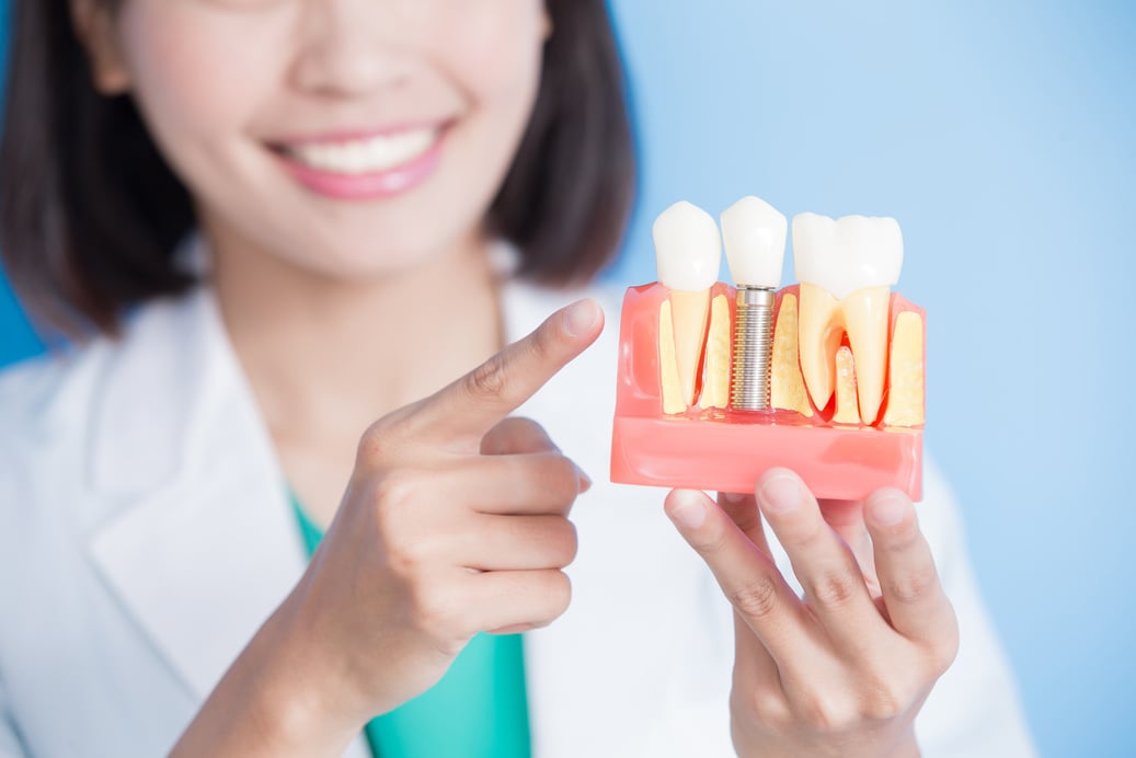 woman dentist take implant tooth